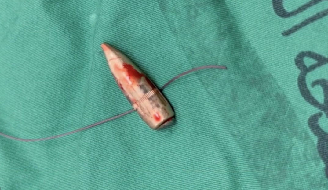 53. Extracted bullet [$2000]